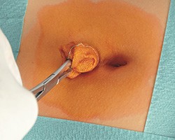 Dezinfekce kůže před chirurgickým zákrokem prostředkem od HARTMANN