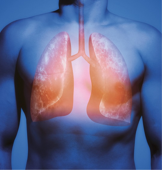 Abbildung Lunge mit Tuberkulose